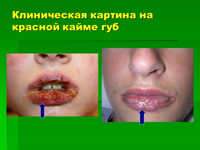 Клиническая картина на красной кайме губ